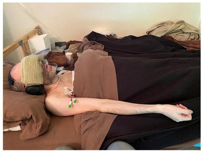 A clinical photograph of a supine patient demonstrating management of severe sensory hypersensitivity in Myalgic Encephalomyelitis/Chronic Fatigue Syndrome (ME/CFS). The image shows a bedridden individual utilizing sensory isolation techniques, including a thick, light-colored folded towel covering the eyes to achieve complete darkness and high-attenuation earmuffs to block auditory stimuli. Visible medical intervention includes a peripherally inserted central catheter (PICC) secured to the upper chest with transparent adhesive dressing. The PICC line features a multi-lumen hub with color-coded (green and purple) needleless connectors, indicating a requirement for total parenteral nutrition (TPN) or intravenous medication due to severe systemic illness. The patient exhibits visible muscle wasting and cachexia, consistent with long-term debilitating illness. This visual illustrates the extreme environmental modifications required for patients with 'very severe' ME/CFS who suffer from profound intolerance to light, sound, and physical presence.
