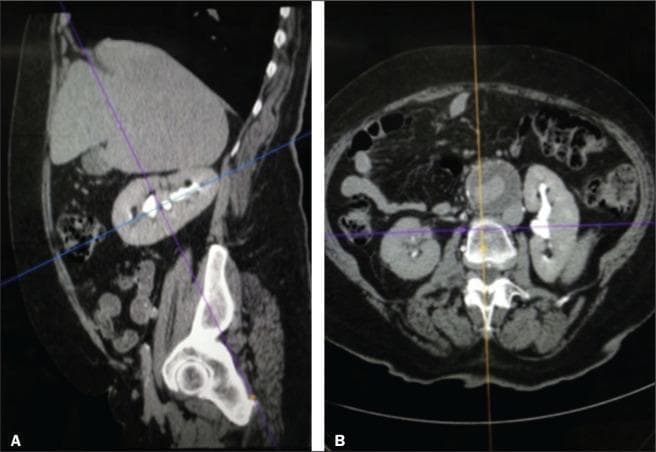 This medical image displays contrast-enhanced computerized tomography (CT) reconstructions of the kidney in two planes: sagittal (A) and axial (B). View A shows a sagittal reconstruction aligned with the renal longitudinal axis, illustrating the bean-shaped profile of the kidney and the natural rotation of the organ relative to the vertical spinal axis. In this view, the upper pole is positioned more medially and posteriorly than the lower pole. The renal parenchyma and hyperdense contrast-filled collecting system are visible. View B shows an axial cross-section of the abdomen, demonstrating the bilateral renal anatomy, the renal cortex, and the collecting system in relation to the vertebral body and abdominal aorta. These reconstructions are used in clinical practice to accurately define renal anatomy for nephrometry scoring systems (such as RENAL or PADUA), which assist in preoperative planning for nephron-sparing surgery. The alignment highlights the importance of using the renal axis rather than the spinal axis for precise anatomical localization of renal masses.