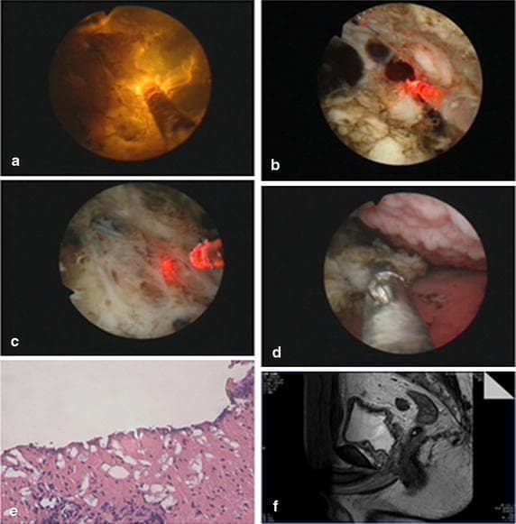 A multi-panel figure illustrating the surgical management and pathology of Benign Prostatic Hyperplasia (BPH) using Plasma-Resection Stripping-Vaporization of the Prostate (PRSVP). Panels (a-d) provide endoscopic views of the procedure: (a) demonstrates a straight beam LBO (green) laser in operation; (b) shows the mechanical stripping of hyperplastic prostate tissue; (c) visualizes the surgical plane at the level of the fibrous prostatic capsule; and (d) depicts the use of endoscopic forceps to retrieve tissue specimens. Panel (e) is a light microscopy image (H&E stain, 10x magnification) of the harvested specimen, confirming prostatic hyperplasia with characteristic glandular and stromal proliferation. Panel (f) is a sagittal T2-weighted MRI of the pelvis, showing the post-operative anatomical results with a widened prostatic urethra and surgical cavity. The collection serves as an educational resource for urological surgery, correlating intraoperative endoscopic findings with histopathology and post-operative radiological assessment.
