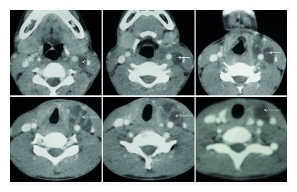 Diagnostic axial CT scan of the neck with contrast demonstrating a large, multiloculated cystic lesion in the left parapharyngeal and cervical space. The image series shows a hypoattenuating (fluid-density) mass indicated by white arrows, characterized by thin, internal enhancing septae. Anatomically, the lesion extends vertically from the level of the mandible down to the C7 vertebral level and the superior mediastinum. It is situated posteromedial to the left sternocleidomastoid muscle, displacing adjacent vascular structures. The clinical presentation is highly suggestive of a branchial cleft cyst or an ectopic cervical thymic cyst. This imaging highlights key diagnostic features of deep neck cystic masses, including internal architecture, density, and spatial relationship to cervical fascia and major vessels, essential for surgical planning and differential diagnosis in otolaryngology and radiology.