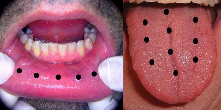 Two-panel clinical photograph and diagram illustrating a treatment protocol for oral conditions using Low-Level Laser Therapy (LLLT). The left panel shows an intraoral view of the lower labial mucosa being retracted. The mucosa appears healthy, pink, and moist. Five black circular markers are overlaid in a linear arrangement across the labial vestibule to indicate the standardized application points for the laser diode. The right panel displays the dorsal surface of the tongue, showcasing the median sulcus and normal filiform and fungiform papillae distribution. Ten black circular markers are superimposed on the tongue to denote specific LLLT application sites: four along the median sulcus and three on each lateral side of the midline. This visual serves as an educational guide for therapeutic mapping in the treatment of symptoms such as burning mouth syndrome or oral mucositis. The imagery belongs to the dental and oral medicine specialty, targeting clinical practitioners and students learning photobiomodulation techniques.