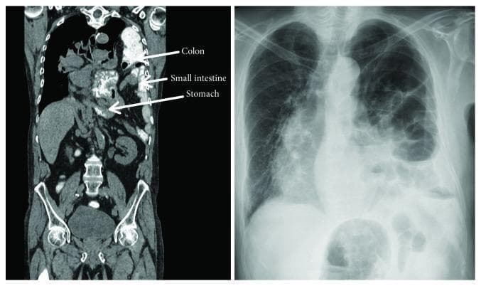 This composite diagnostic image features a side-by-side comparison of a coronal CT scan and a posterior-anterior (PA) chest X-ray illustrating a massive left-sided traumatic diaphragmatic hernia. The coronal CT image (left) uses labeled arrows to demonstrate the displacement of abdominal viscera into the thoracic cavity, including the stomach, small intestine, and colon. The diaphragm is clearly ruptured on the left side, while the liver remains in its normal position in the right upper quadrant. The chest X-ray (right) reveals multiple loops of air-filled bowel occupying the left hemithorax, resulting in significant compression of the left lung and a contralateral mediastinal shift of the heart and trachea toward the right. There is an associated obscuration of the left costophrenic angle and hemidiaphragm silhouette. These images serve as classic clinical examples of acute respiratory insufficiency caused by visceral herniation following diaphragmatic injury, highlighting the importance of multimodality imaging in diagnosing thoracic trauma.