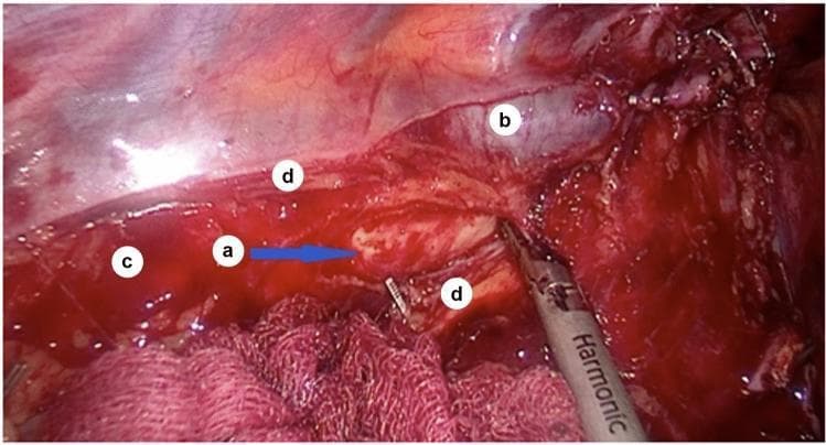 An intraoperative endoscopic photograph showing the surgical anatomy of the posterior mediastinum during a thoracic procedure. The operative field highlights the sulcus azygoaortalis (labeled 'c'), a physiological groove located between the descending thoracic aorta and the azygos vein. The adventitia of the thoracic aorta (labeled 'a') is visible through the dissection site. The azygos vein (labeled 'b') is positioned adjacent to the aortic wall. The mediastinal pleura has been incised and reflected, with its edges (labeled 'd') clearly demarcated at the periphery of the dissection. A harmonic scalpel or ultrasonic dissector is visible in the lower right, positioned near the operative site. This image demonstrates the critical anatomical relationships required for mobilization of the esophagus and identification of the thoracic duct, which typically resides within the loose connective tissue of this sulcus. The orientation reflects a sagittal surgical plane used during lymphadenectomy or esophageal surgery.