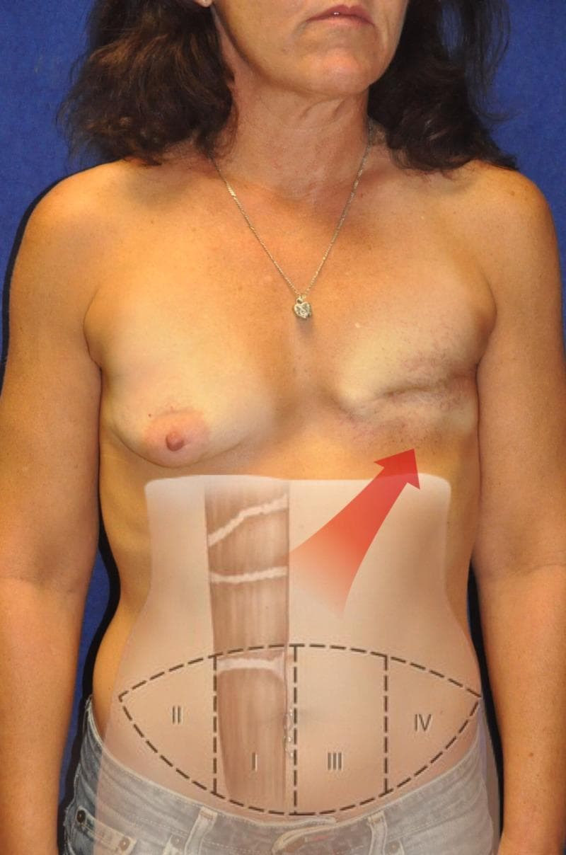 This clinical photograph and superimposed diagram illustrate a preoperative assessment for breast reconstruction following a left-sided mastectomy. The patient displays a natural right breast and a flattened left chest wall with a horizontal surgical scar and signs of radiation-induced skin changes. Overlaid on the abdomen is a schematic representing the Holm vascular zone classification for a Transverse Rectus Abdominis Myocutaneous (TRAM) flap. The diagram divides a transversely oriented elliptical donor site into four zones (I-IV) based on the rectus abdominis muscle midline. Zone I represents the primary vascular territory over the donor muscle pedicle. Zone II is lateral to Zone I on the ipsilateral side. Zone III is across the midline adjacent to Zone I, and Zone IV is the most lateral contralateral area. A red arrow indicates the intended flap transposition from the right abdominal donor site to the left mastectomy recipient site. This visual is designed for plastic surgery education, specifically regarding autologous tissue transfer and flap perfusion planning.