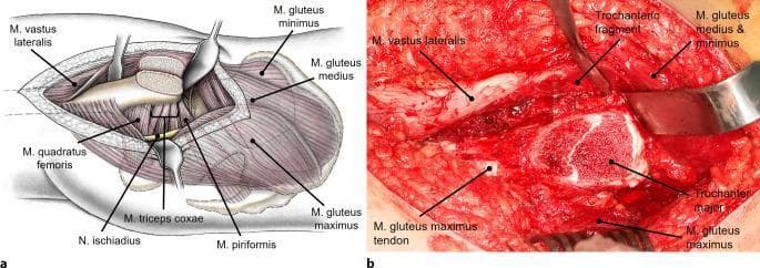 This composite educational resource demonstrates a trochanteric flip osteotomy for surgical hip dislocation. Panel A is a labeled anatomical diagram illustrating the surgical site after the osteotomy. Key structures shown include the mobilized trochanteric fragment with the vastus lateralis, gluteus medius, and gluteus minimus muscles attached. Deep structures visible include the piriformis, triceps coxae, quadratus femoris, and the sciatic nerve (N. ischiadicus). Panel B is a corresponding intraoperative clinical photograph providing a real-world perspective of the same surgical stage. It highlights the separated trochanteric fragment held by a surgical retractor, the exposed greater trochanter (trochanter major), and the mobilized gluteus medius and minimus muscles. The image serves to teach the surgical approach and relevant musculoskeletal anatomy necessary to preserve femoral head perfusion during hip reconstruction, emphasizing the anterior mobilization of the trochanteric fragment to expose the hip joint capsule while maintaining the integrity of the attached musculature.