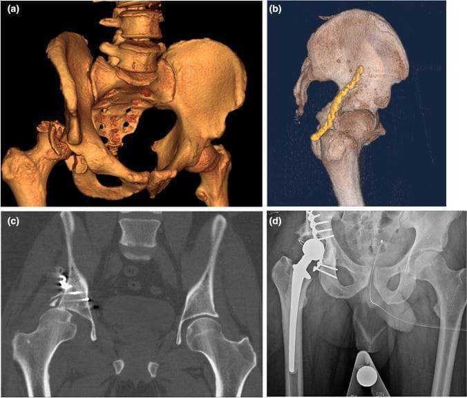 A multi-panel clinical imaging series documenting the progression and surgical management of a complex hip injury. (a) 3D reconstructed CT scan of the pelvis showing a comminuted posterior wall acetabular fracture with associated posterior hip dislocation. (b) 3D CT reconstruction demonstrating postoperative internal fixation using a curved metallic plate and screws along the posterior acetabular rim. (c) Coronal 2D CT slice showing osteosynthesis failure, characterized by hardware displacement, loss of reduction, and superior subluxation of the femoral head. (d) Anteroposterior (AP) pelvic radiograph following salvage surgery, illustrating a cemented total hip arthroplasty (THA). The radiopacity of the prosthetic femoral stem, acetabular cup, and cerclage wiring is clearly visible. The series illustrates the clinical transition from primary Open Reduction Internal Fixation (ORIF) failure to secondary arthroplasty in orthopaedic trauma management.