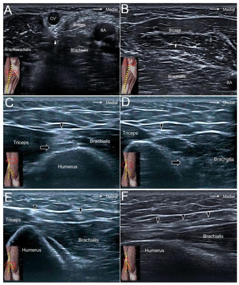 A composite clinical diagnostic image featuring six ultrasound panels (A-F) that demonstrate the sonographic appearance and anatomical landmarks of upper limb cutaneous nerves. Panel A and B (cross-sectional) show the lateral antebrachial cutaneous nerve (white arrowhead) at the elbow crease and distal forearm, illustrating its proximity to the cephalic vein (CV), biceps brachii muscle, and brachial artery (BA). Panels C, D, and E (cross-sectional) visualize the posterior antebrachial cutaneous nerve (black arrowhead) as it exits the spiral groove, descends into the distal forearm, and passes near the lateral epicondyle. These views highlight the nerve's superficial position relative to the triceps brachii muscle, brachialis muscle, and humerus. Panel F provides a long-axis longitudinal view of the posterior antebrachial cutaneous nerve, showing its linear hyperechoic trajectory along the brachialis fascia. Black arrows in C and D indicate the radial nerve's deeper course. Small anatomical orientation diagrams in each panel correlate the sonographic probe position with the arm's surface anatomy.