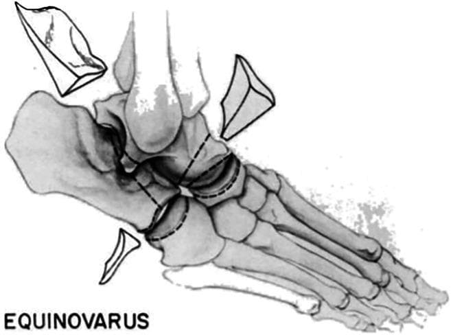 Anatomical diagram illustrating the Hoke technique for triple arthrodesis in the context of equinovarus deformity correction. The illustration depicts a lateral-oblique view of the human foot and ankle skeletal structure. Three distinct wedge-shaped bone resections are shown as detached segments to indicate their removal: one from the talar neck/head, one from the posterior facet of the subtalar joint (calcaneus), and one from the calcaneocuboid joint area. Dashed lines on the main skeletal body mark the precise sites of the osteotomies across the subtalar, talonavicular, and calcaneocuboid joints. The educational focus is on the osseous reshaping required to achieve a plantigrade foot position by reducing the equinus and varus components of the deformity. The diagram labels the condition as 'EQUINOVARUS' to provide clinical context for the surgical intervention, which targets the stabilization and alignment of the hindfoot and midfoot complexes through joint fusion.