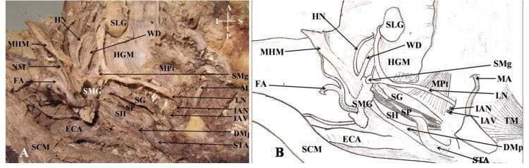 This composite educational resource comprises a clinical photograph of a cadaveric dissection (A) and a matching schematic diagram (B), providing a lateral view of the human infratemporal fossa and submandibular region. The visual focus is the spatial relationship between the salivary glands, neurovascular structures, and musculature. Key anatomical landmarks include the submandibular gland (SMG) and sublingual gland (SLG), with the Wharton duct (WD) shown originating from the SMG. The dissection reveals the mylohyoid muscle (MHM) partially reflected to expose the deeper hyoglossus muscle (HGM). Neural structures are clearly labeled, including the lingual nerve (LN), hypoglossal nerve (HN), inferior alveolar nerve (IAN), and the submandibular ganglion (SMg). The styloid apparatus is demonstrated through the styloglossus (SG), stylohyoid (SH), and stylopharyngeus (SP) muscles. Vascular components include the external carotid artery (ECA), maxillary artery (MA), and facial artery (FA). This image serves as an advanced anatomical reference for medical students and surgical trainees focusing on head and neck anatomy, particularly regarding the complex arrangement of the floor of the mouth and the parapharyngeal space.