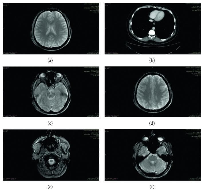 This composite figure presents six diagnostic images illustrating cross-sectional anatomy of the head and thorax. The majority of the images (a, c, d, e, f) are axial Magnetic Resonance Imaging (MRI) scans of the brain at various neuroanatomical levels. (a) and (d) depict the superior cerebrum, highlighting the cerebral cortex, gyri, sulci, and the longitudinal fissure. (c) shows a mid-level axial section including the orbits and temporal lobes. (e) and (f) represent the posterior fossa and skull base, detailing the cerebellum and brainstem. In contrast, image (b) is an axial section of the thorax, likely a Computed Tomography (CT) scan, showing the cardiac silhouette, the ascending and descending aorta, the vertebral body, and the pulmonary parenchyma. These images serve as examples of clinical neuroimaging and thoracic radiology, demonstrating the visualization of soft tissue structures, bony landmarks, and fluid-filled cavities (such as ventricles and orbits) across different imaging modalities and anatomical planes for educational and diagnostic purposes.