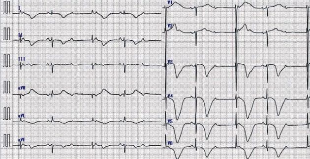 A 12-lead electrocardiogram (ECG) demonstrating a clinical case of complete atrioventricular (AV) block. The tracing shows a slow ventricular rate of approximately 40 beats per minute with evidence of AV dissociation, where P waves and QRS complexes occur independently of one another. The QRS complexes are wide, suggesting a junctional or ventricular escape rhythm. Significant repolarization abnormalities are present, most notably deep, symmetric T-wave inversions in the lateral (I, aVL) and inferior (II, aVF) leads, as well as throughout the precordial leads (V3-V6). These diffuse T-wave changes are characteristic findings that can be associated with Takotsubo cardiomyopathy (TCM) or severe myocardial ischemia. The ECG layout follows a standard format with limb leads (I, II, III, aVR, aVL, aVF) on the left and precordial leads (V1-V6) on the right, providing a comprehensive view of cardiac electrical activity and conduction disturbances.