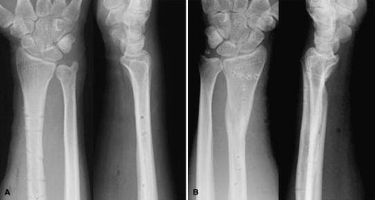This diagnostic image consists of four x-ray radiographs showing the right (A) and left (B) forearms and wrists in both anteroposterior and lateral projections at a 13-month follow-up. The images demonstrate successful bone union following bilateral Galeazzi fracture-dislocations. The radius shafts in both forearms exhibit consolidated fractures with visible bone remodeling and small, circular radiolucent voids corresponding to screw holes from removed surgical hardware (plate and screw fixation). Specifically, the left radius (B) shows a more complex, formerly comminuted area now bridged by dense bone. The distal radio-ulnar joints (DRUJ) are well-aligned in all views; the distal ulnar heads are appropriately seated within the sigmoid notches of the radii without evidence of dorsal subluxation or dislocation. The carpal bones appear normal in density and configuration. These radiographs illustrate the long-term clinical outcome of anatomical fracture reduction and stabilization of the DRUJ, confirming stable joint congruity and mature bone healing after orthopedic intervention.