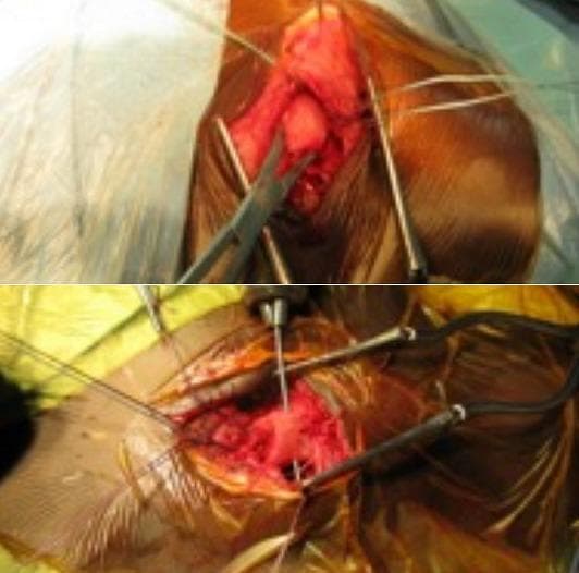 This composite clinical photograph displays two sequential stages of an osteo-periosteal suture procedure during orthopedic surgery, specifically focusing on the medial clavicle. The top panel illustrates fracture reduction using Jayle's forceps to manipulate and realign the bone fragments within an open surgical field. Retractors are positioned to provide visualization of the red, vascularized periosteal tissue and underlying bone. The bottom panel demonstrates the next stage: bone perforation using a drill bit held in a Jacobs chuck. This step facilitates the passage of non-resorbable sutures for final fixation. Multiple surgical retractors, stay sutures, and sterile adhesive drapes are visible throughout the intraoperative site. The image serves as a teaching tool for surgical techniques in managing sternoclavicular joint injuries or clavicular epiphysiolysis, highlighting the transition from anatomical reduction to mechanical preparation for internal fixation.