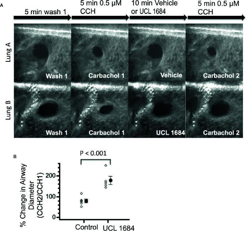 This medical research graphic illustrates the effects of the M3 muscarinic receptor antagonist UCL 1684 on bronchial smooth muscle contractility using mouse lung slices.
Panel A presents two rows of phase-contrast or similar medical imaging of precision-cut lung slices (Lung A and Lung B). The sequences demonstrate airway responses to carbachol (CCH), a cholinergic agonist that induces bronchoconstriction. In the control row (Lung A), the airway constricts after CCH exposure and remains narrowed despite vehicle application. In the treatment row (Lung B), the application of UCL 1684 reverses the CCH-induced constriction and effectively prevents subsequent bronchoconstriction during a second CCH challenge, maintaining a dilated bronchial diameter.
Panel B shows a quantitative bar graph summarizing the percentage change in airway diameter. It compares the control group to the UCL 1684-treated group, demonstrating a statistically significant difference (P < 0.001) in airway patency. The content focuses on pharmacology, pulmonology, and the physiological mechanisms of M3 muscarinic receptor antagonism in managing airway hyperresponsiveness.