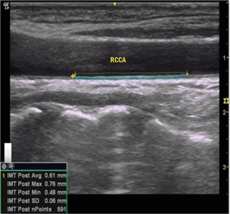 This diagnostic image is a longitudinal B-mode ultrasound of the Right Common Carotid Artery (labeled RCCA), demonstrating the assessment of Carotid Intima-Media Thickness (CIMT). The vessel lumen is shown as an anechoic (dark) space, while the posterior arterial wall exhibits a characteristic double-line pattern representing the interface between the blood-intima and the media-adventitia. A cyan measurement tool is overlaid on a plaque-free segment of the posterior wall, tracing the tunica intima and tunica media layers. A data box in the lower left corner provides quantitative metrics: an average IMT of 0.61 mm, a maximum of 0.76 mm, a minimum of 0.48 mm, and a standard deviation of 0.06 mm across 591 measurement points. This imaging modality is primarily used in cardiovascular risk stratification and the screening of subclinical atherosclerosis, providing a non-invasive surrogate marker for systemic vascular health and future cardiovascular events.