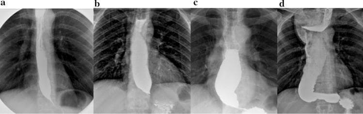 A series of four diagnostic X-ray radiography images (a-d) showing a barium swallow study illustrating the progressive stages of achalasia. All images demonstrate a 'bird’s beak' appearance at the gastroesophageal junction (EGJ) due to distal esophageal narrowing and impaired relaxation. Stage I (a) shows a straight esophagus with a maximum diameter ≤4 cm. Stage II (b) exhibits moderate dilation between 4–6 cm while maintaining a straight vertical axis. Stage III (c) demonstrates significant dilation ≥6 cm but remains relatively straight. Stage IV (d) represents end-stage disease with marked dilation (≥6 cm) and a characteristic 'sigmoid' or S-shaped configuration, indicating advanced esophageal tortuosity and loss of longitudinal muscle tone. The contrast distribution shows increasing proximal pooling and stasis as the disease progresses from Stage I to Stage IV, illustrating the severity of functional obstruction and esophageal decompensation.