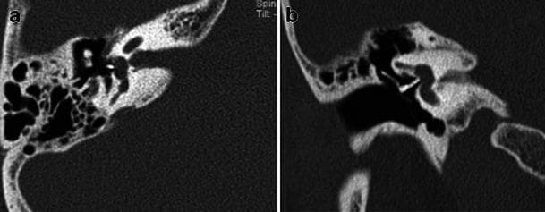 This diagnostic image displays a high-resolution computed tomography (HRCT) scan of the right temporal bone in axial (a) and coronal (b) planes. The scan highlights postoperative findings following a stapedectomy for the treatment of otosclerosis. A radiodense stapes prosthesis is clearly visualized, exhibiting high attenuation relative to the surrounding soft tissue and middle ear air space. In the axial view (a), the prosthesis is correctly positioned in the middle ear cavity, extending toward the region of the oval window. The coronal view (b) demonstrates the anatomical relationship between the incus and the oval window, showing the distal end of the prosthesis well-seated against the oval window membrane. Other visible structures include the pneumatized mastoid air cells, the ossicular chain, and the bony otic capsule. These views are clinically essential for verifying correct hardware placement and ruling out postoperative complications such as prosthesis displacement or protrusion into the vestibule.