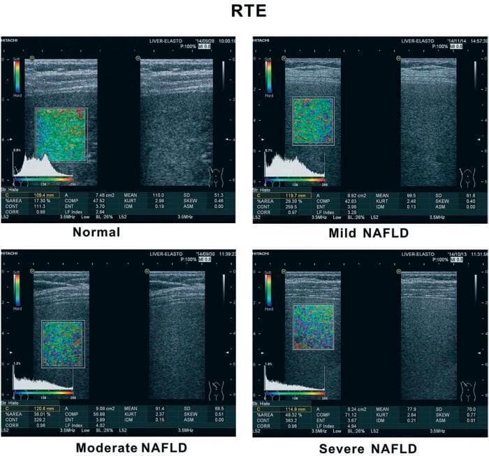A comparative diagnostic image panel demonstrating Real-time Tissue Elastography (RTE) of the liver across four clinical stages: Normal, Mild Nonalcoholic Fatty Liver Disease (NAFLD), Moderate NAFLD, and Severe NAFLD. Each quadrant displays a B-mode ultrasound image of the liver parenchyma paired with a corresponding color-coded elastogram overlay and a histogram of strain distribution. The color scale indicates tissue stiffness, ranging from blue (hard) to red (soft). Progression from normal to severe NAFLD shows an increase in tissue heterogeneity and a visible shift in the histogram morphology. Quantitative parameters below each image track the evolution of disease, specifically showing an increasing '%AREA' (17.30% to 48.32%) and a decreasing 'MEAN' elasticity value (110.0 to 77.9), alongside increasing standard deviation (SD) values. This visual comparison illustrates the use of strain elastography to non-invasively assess and stage liver steatosis and fibrosis, providing critical diagnostic markers for metabolic liver disease management.