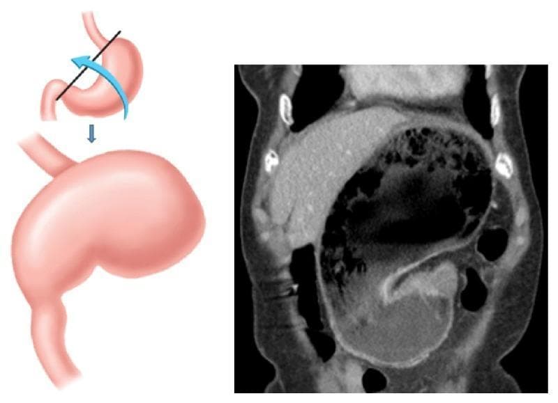 The image consists of a two-part educational composite illustrating organoaxial gastric volvulus. The left panel is a pathophysiology diagram depicting the mechanism of rotation: the stomach rotates along its longitudinal axis (the line connecting the gastroesophageal junction and the pylorus), indicated by a blue arrow. Below the rotation diagram, a second illustration shows the resulting massive gastric distention. The right panel is a coronal CT scan of the abdomen confirming these clinical findings. The CT demonstrates a grossly distended stomach occupying a significant portion of the abdominal cavity, containing mixed air and fluid levels, characteristic of a gastric outlet obstruction. Additionally, the CT reveals hyperdense intraperitoneal fluid within the paracolic gutters and pelvic recesses, highly suggestive of hemoperitoneum. This combination of findings highlights the risk of vascular compromise or splenic ligamentous traction associated with organoaxial torsion. The content is suitable for medical education regarding surgical emergencies and gastrointestinal radiology.