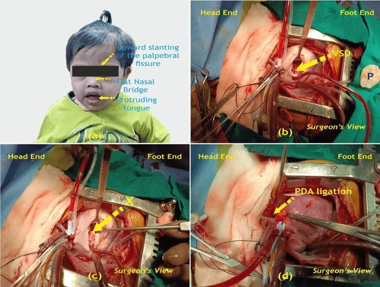 A multi-panel medical image illustrating the clinical presentation and surgical management of congenital heart disease in a pediatric patient with Trisomy 21 (Down Syndrome). Panel (a) is a clinical photograph of a child displaying characteristic dysmorphic facial features, including upward slanting palpebral fissures, a flat nasal bridge, and a protruding tongue. Panels (b), (c), and (d) provide intraoperative views during a median sternotomy. Panel (b) shows the exposed heart before surgical repair, identifying a ventricular septal defect (VSD) and a glutaraldehyde-treated pericardial patch (P) ready for use. Panel (c) demonstrates the intraoperative site after the VSD has been successfully closed with the patch (marked X). Panel (d) displays the ligation of a patent ductus arteriosus (PDA). The surgical images are labeled from the 'Surgeon's View' with 'Head End' and 'Foot End' orientations provided. This composite image serves to correlate the phenotypic features of Trisomy 21 with common associated cardiac anomalies (VSD and PDA) and their definitive surgical correction.