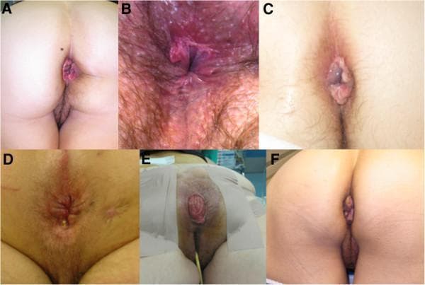 A composite of six clinical photographs (labeled A through F) illustrating various benign anorectal conditions. A: Features prolapsed internal hemorrhoids presenting as reddish-purple, vascular tissue protruding through the anal orifice. B: Demonstrates an anal fissure characterized by erythema, inflammation, and visible mucosal tearing in the perianal region. C: Shows a thrombosed external hemorrhoid, appearing as a smooth, tense, bluish-purple perianal mass. D: Displays an anal fistula with visible scarring, skin induration, and a punctate external opening with purulent drainage. E: A clinical view of a full-thickness rectal prolapse, showing a concentric, erythematous protrusion of the rectal wall with visible circular mucosal folds, captured in a perioperative setting. F: Illustrates anal skin tags (acrochordons), which are hypertrophied, skin-colored, painless connective tissue folds at the anal verge. This collection serves as a visual diagnostic guide for medical education, emphasizing morphology, color, and anatomical location of common proctological pathologies.