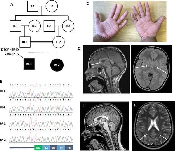 Multi-panel figure combining clinical genetics and neuroimaging. (A) Pedigree chart showing autosomal recessive inheritance in a consanguineous family. (B) Sanger sequencing chromatograms identifying a homozygous c.1A>T (p.Met1?) mutation in the PIGH gene for the affected siblings (IV-1, IV-2), with parents as heterozygous carriers. (C) Clinical photograph of an 8-year-old child's hands exhibiting bilateral clinodactyly of the fifth fingers. (D, E) Sagittal T1-weighted MRI images of the siblings showing mild dysplasia of the corpus callosum, specifically characterized by a truncated and slightly rounded appearance of the rostrum (white arrows). (D, right) Axial T2 FLAIR sequence showing hyperintense signals in the globus pallidi, more prominent on the right. (F) Axial T2-weighted MRI scan demonstrating bilateral, non-specific hyperintense foci in the deep white matter of the parietal regions (white arrows). The figure illustrates the clinical and molecular findings associated with PIGH-related glycosylphosphatidylinositol (GPI) anchor deficiency, categorized under clinical genetics and neuroradiology.