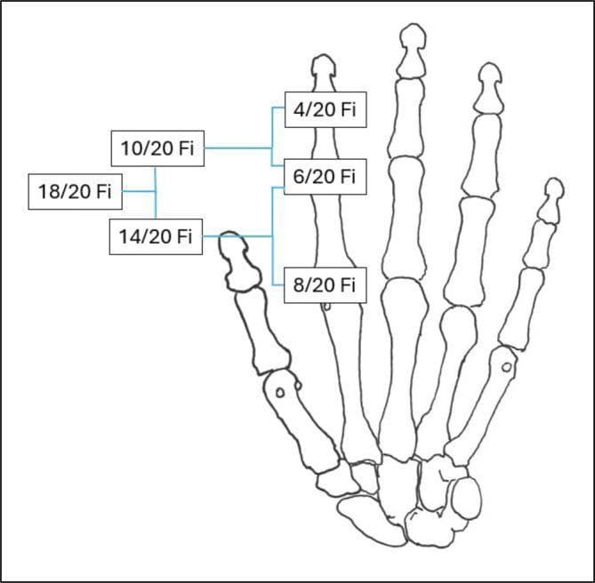 Anatomical diagram and chart representing the skeletal structure of a human hand, specifically used for legal medicine and insurance assessment (AUB). The illustration shows the carpal bones, metacarpals, and phalanges of the five digits. It features specialized annotations representing disability values (Invaliditätswerte) for joint stiffening (ankylosis) in functionally favorable positions. The labels utilize a fractional format 'x/20 Fi' (Fingerwert), which refers to standardized assessment scales for hand function impairment. Labels '4/20 Fi', '6/20 Fi', and '8/20 Fi' are linked to specific joints of the index finger, while '10/20 Fi', '14/20 Fi', and '18/20 Fi' are associated with the thumb ray (pollex). This clinical algorithm diagram is designed for orthopedic surgeons and medical examiners to determine functional loss in medical-legal contexts regarding upper extremity injuries.