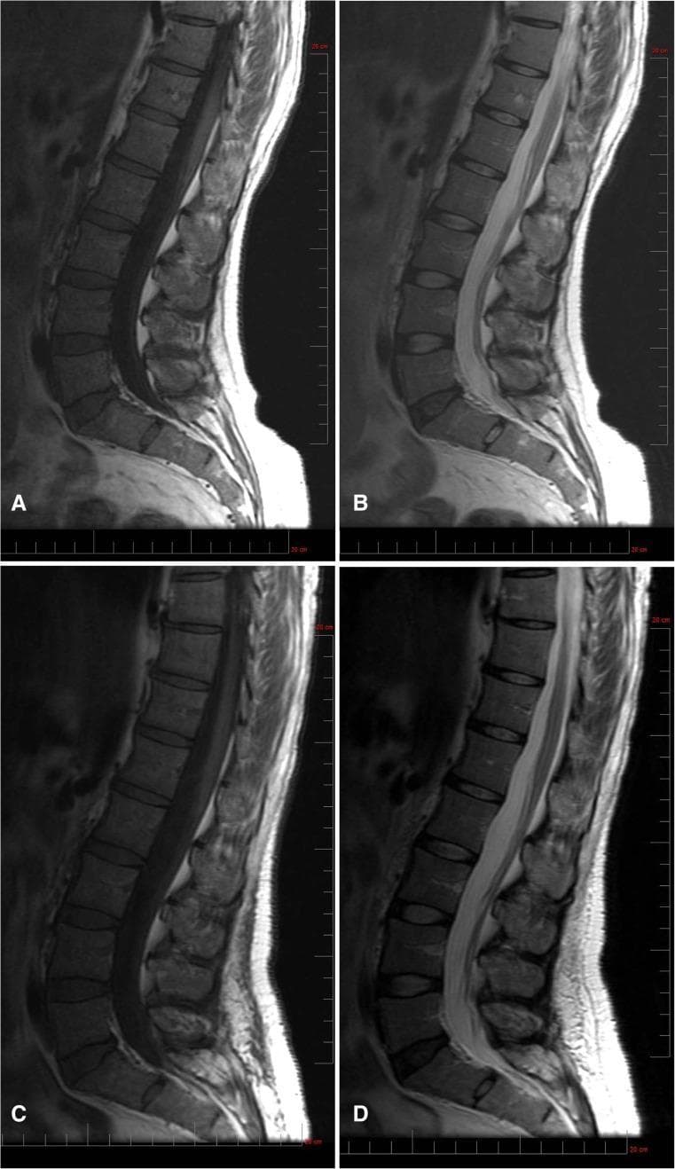 This diagnostic comparison uses Magnetic Resonance Imaging (MRI) to assess Bone Marrow Burden (BMB) in a patient with Niemann-Pick disease type B, specifically focusing on the lumbar spine. The panel presents sagittal views at baseline (A and B) and after 30 months of olipudase alfa treatment (C and D). Figures A and C are T1-weighted images, while B and D are T2-weighted. At baseline, the T1-weighted sequence (A) demonstrates diffuse infiltrative disease characterized by bone marrow isointensity relative to the intervertebral discs. The baseline T2-weighted image (B) shows hyperintense signal within the presacral fat. Following 30 months of enzyme replacement therapy, the T1-weighted image (C) indicates that marrow infiltration remains largely unchanged. However, the T2-weighted sequence (D) reveals improvement in the presacral fat signal, which has transitioned to a slightly hyperintense state. This longitudinal comparison illustrates the variable response of different anatomical compartments to treatment, emphasizing the use of signal intensity shifts as a metric for monitoring marrow infiltration and clinical progression in metabolic storage disorders.
