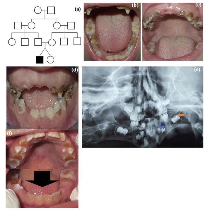 This composite image illustrates clinical and radiographic features of Dentinogenesis Imperfecta (DI) in a pediatric patient. Panel (a) shows a pedigree indicating a familial inheritance pattern. Panels (b, c, d, f) are intraoral clinical photographs showing both primary and permanent dentition. The teeth exhibit characteristic amber-to-opalescent discoloration, significant enamel attrition, and bulbous crown morphology. Severe destruction of the clinical crowns is visible, particularly in the deciduous teeth. Panel (e) is a panoramic radiograph demonstrating hallmark diagnostic features of DI, including bulbous molar crowns with cervical constriction, thin or shortened roots (blue arrow), and enlarged pulp chambers (orange arrow), indicating a failure of normal dentin deposition. The radiographic appearance also shows a lack of clear demarcation between the enamel and dentin layers. This collection of images serves as a clinical reference for the diagnosis of hereditary dentin defects, specifically DI Type II, commonly associated with DSPP gene mutations.