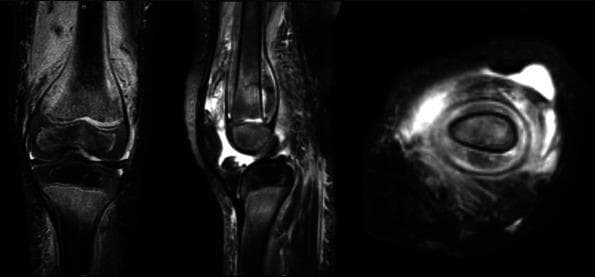 This diagnostic image set consists of three magnetic resonance imaging (MRI) views—coronal, sagittal, and axial—of a pediatric knee joint, illustrating advanced findings of scurvy (vitamin C deficiency). The T2-weighted or fluid-sensitive sequences reveal prominent, circumferential high-signal intensity fluid collections located beneath the periosteum of the distal femur and proximal tibia. This subperiosteal hemorrhage appears as a thick layer of fluid that elevates the periosteum away from the cortical bone. The coronal and sagittal views highlight the longitudinal extent of the hemorrhage along the metaphyses, while the axial view demonstrates the circumferential nature of the fluid collection around the femoral shaft. Additionally, there is evidence of diffuse bone marrow edema and soft tissue swelling. These findings are characteristic musculoskeletal manifestations of scurvy in children, resulting from impaired collagen synthesis and subsequent capillary fragility. The image serves as an educational tool for distinguishing nutritional deficiencies from other marrow infiltrative or inflammatory processes using advanced imaging.