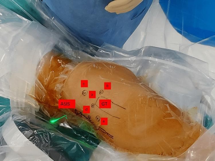This clinical photograph illustrates the standard arthroscopic portals and anatomical landmarks of the hip, prepared for a surgical procedure. The patient is shown in a lateral decubitus position, covered with transparent sterile surgical drapes. Key surface landmarks are marked with red labels, including the Anterior Superior Iliac Spine (ASIS) and the Greater Trochanter (GT). Five specific arthroscopic portal sites are identified with lettered red labels: (a) anterolateral portal, located at the superior border of the greater trochanter; (b) posterolateral portal, situated posterior to the anterolateral portal; (c) supratrochanteric portal, positioned superiorly toward the iliac crest; (d) anterior portal, located distal to the ASIS; and (e) mid-anterior portal, positioned inferior and lateral to the anterior portal. This image serves as a procedural guide for orthopedic surgeons and residents, demonstrating the spatial relationships and surface anatomy required for safe portal placement during hip arthroscopy to access the central and peripheral compartments.