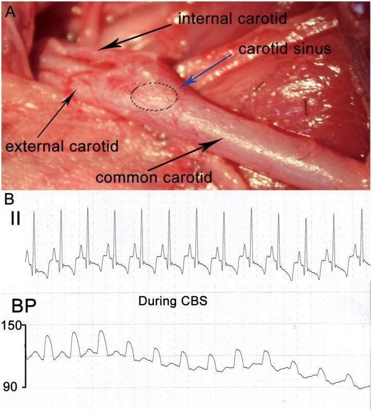This composite educational image illustrates the anatomy and physiological effects of carotid baroreceptor stimulation (CBS).
Panel A is a clinical photograph of a surgical dissection showing the carotid bifurcation. Black arrows identify the common carotid artery, external carotid artery, and internal carotid artery. A blue arrow and dashed oval highlight the carotid sinus, a baroreceptor-rich region located at the bulbous origin of the internal carotid artery.
Panel B provides a physiological tracing during CBS. The top trace is a Lead II electrocardiogram (ECG) showing rhythmic cardiac cycles. The bottom trace represents continuous arterial blood pressure (BP) monitoring on a scale from 90 to 150 mmHg. The recording demonstrates a clear depressor response during CBS, characterized by a progressive decline in mean blood pressure and a reduction in heart rate.
This image is designed for medical studies in cardiology and autonomic physiology, illustrating the baroreflex mechanism used to modulate cardiovascular parameters through therapeutic electrical stimulation.