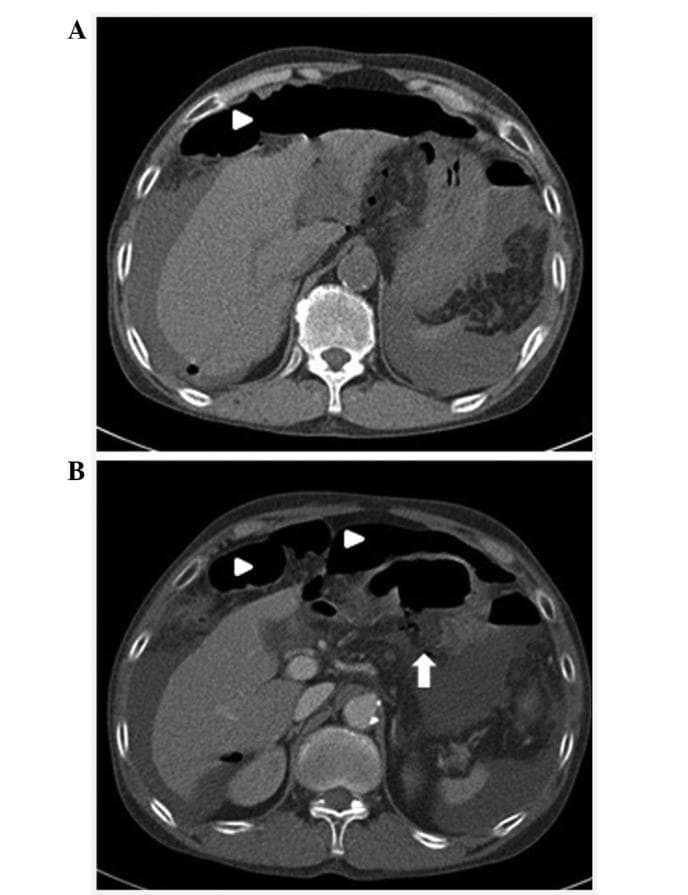 This diagnostic image consists of two axial abdominal computed tomography (CT) scans, labeled A and B, demonstrating complications from a hollow viscus perforation in the context of chronic liver disease. Image A (upper panel) shows significant pneumoperitoneum, visualized as prominent anterior free air collections (arrowhead), and a markedly shrunken, nodular liver consistent with cirrhosis. High-attenuation fluid is present in the paracolic gutters and perisplenic space, suggesting ascites or hemoperitoneum. Image B (lower panel) shows more localized free air (arrowheads) and identifies the likely source of the pneumoperitoneum: a gastric ulcer perforation located at the posterior wall of the gastric antrum (indicated by the white arrow). The imaging findings collectively illustrate a surgical emergency involving a perforated peptic ulcer in a patient with underlying portal hypertension and hepatic atrophy. These scans are critical for medical students and radiology residents in identifying the classic radiographic signs of extraluminal gas, abdominal fluid collection, and secondary signs of liver cirrhosis.