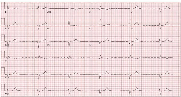 A standard 12-lead electrocardiogram (ECG) demonstrating a bradycardic rhythm at approximately 35 beats per minute. The baseline shows a fine, irregular fibrillatory pattern without organized P waves, most prominent in lead V1, consistent with underlying atrial fibrillation. The ventricular response is regular, indicating AV dissociation and a high-grade or complete heart block (CHB) with a junctional or ventricular escape rhythm. The QRS complexes are wide (approximately 160 ms), exhibiting a broad, notched, or slurred morphology. Lead V1 shows a predominantly negative QRS complex. The ST segments are largely isoelectric across most leads; however, non-specific T-wave inversions are present in the lateral leads (I and aVL), and there is generalized low T-wave amplitude. This ECG is a classic representation of CHB in the setting of permanent atrial fibrillation, demonstrating the characteristic 'regularized' rhythm that signifies total AV nodal conduction failure.