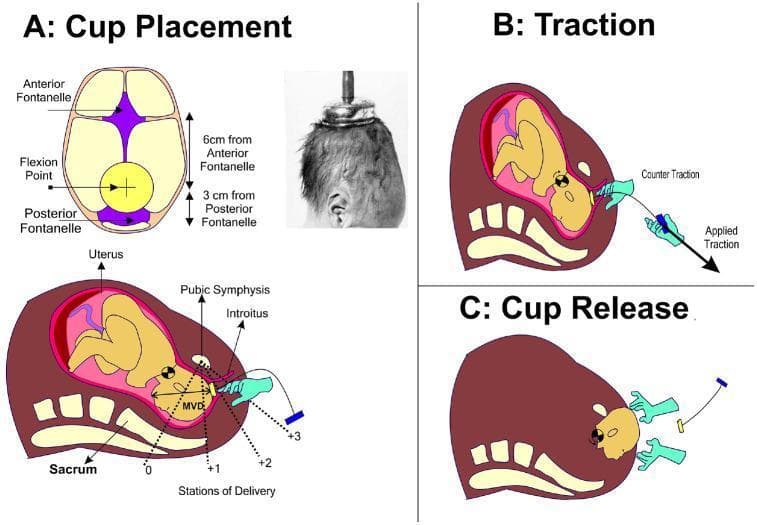This educational graphic illustrates the procedural steps and anatomical considerations for Vacuum-Assisted Delivery (VAD). Panel A, 'Cup Placement', features a superior-view diagram of a fetal skull and a clinical photograph. It defines the 'flexion point' along the sagittal suture, located 6 cm from the anterior fontanelle and 3 cm from the posterior fontanelle. A sagittal cross-section shows the fetus in the uterus, identifying landmarks like the pubic symphysis, sacrum, and stations of delivery (0 to +3). Panel B, 'Traction', demonstrates the application of force. One hand provides 'Applied Traction' along the pelvic axis, while the other provides 'Counter Traction' at the introitus to stabilize the vacuum cup. Panel C, 'Cup Release', depicts the removal of the vacuum device once the fetal head has successfully crowned. This diagram is designed for obstetrics education, emphasizing correct cup positioning to facilitate head flexion and descent through the birth canal while minimizing maternal and neonatal trauma.