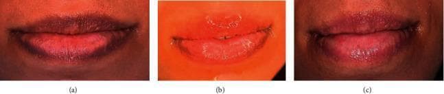 A series of three clinical photographs (a, b, and c) documenting a chronological progression of lip depigmentation treatment. Image (a) represents the baseline state, showing diffuse dark melanin hyperpigmentation on the upper and lower lips with a clearly defined vermilion border. Image (b) shows the immediate post-procedure state following laser resurfacing; the lips exhibit significant erythema, mild edema (swelling), and a glossy, exudative surface consistent with acute inflammatory response. Image (c) demonstrates the final clinical outcome after complete wound healing, typically around 14 days post-treatment. The lips show a successful reduction in melanin pigmentation, resulting in a lighter, pinker, and more uniform color. The swelling has fully resolved, and the natural vermilion border and lip contours are restored without visible scarring. This comparison serves as an educational tool for laser dermatology and aesthetic medicine, illustrating the stages of healing and efficacy of laser-assisted lip depigmentation.