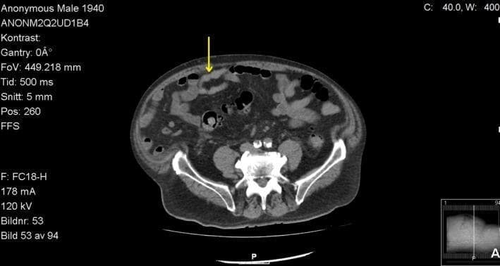 This diagnostic image is an axial non-contrast computerized tomography (CT) scan of the lower abdomen and upper pelvis. The scan demonstrates significant pathology consistent with portal hypertension. A prominent yellow arrow indicates dilated, tortuous paraumbilical veins (caput medusae) located within the anterior abdominal wall. These collateral vessels appear as tubular, soft-tissue density structures protruding through the subcutaneous fat near the midline. Key anatomical landmarks visible include the iliac wings, the sacrum, the vertebral body, and loops of both small and large bowel with intraluminal gas. The abdominal wall musculature is clearly defined. This image serves as a clinical illustration of portosystemic shunting, specifically the recanalization of the ligamentum teres, commonly seen in advanced liver cirrhosis. It is intended for intermediate to advanced medical learners studying hepatology, gastroenterology, and diagnostic radiology.