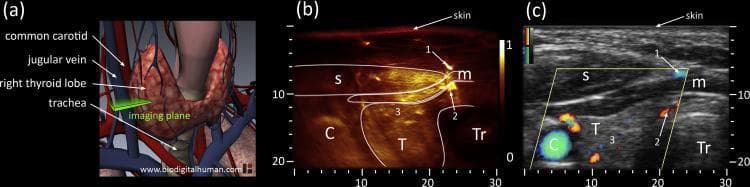 This composite educational graphic illustrates the cross-sectional anatomy of the anterior neck, focusing on the left thyroid lobe through three modalities: (a) a 3D anatomical diagram, (b) an optoacoustic image, and (c) a correlative ultrasound with Directional Power Doppler. The 3D diagram establishes the spatial orientation of the common carotid artery, jugular vein, trachea, and thyroid lobe. The optoacoustic cross-section (b) displays high-sensitivity vascular mapping, identifying the sternocleidomastoid (s) and infrahyoid (m) muscles, the carotid artery (C), and the trachea (Tr). Intraglandular vascularity (3) and superficial vessels (1, 2) are highlighted in a high-contrast heatmap. The corresponding ultrasound image (c) provides structural grayscale context with superimposed Doppler signals (red and blue) indicating blood flow direction. This multimodal comparison demonstrates how optoacoustic imaging provides superior visualization of microvascular networks within the thyroid gland (T) compared to standard Doppler ultrasound, while maintaining consistent anatomical landmarks such as the trachea's medial position and the lateral placement of the carotid artery.