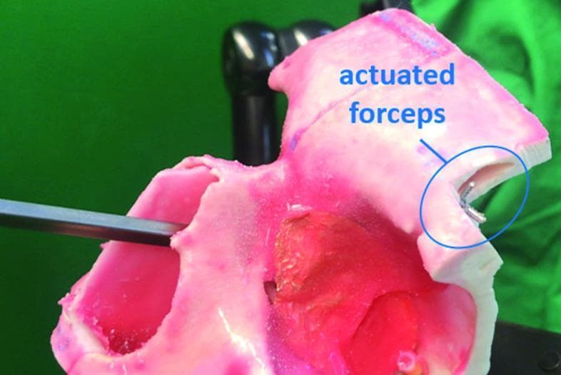 This clinical photograph displays a medical simulation setup for functional endoscopic sinus surgery (FESS), specifically demonstrating the reachability of a novel manipulator system within the lateral region of the frontal sinus. The image features a pink, semi-translucent anatomical phantom representing the human frontal sinus, including internal cavities and regions of varying density to simulate pathological tissue. A flexible surgical manipulator arm is inserted through the sinus floor (simulated Draf IIa window). At the distal end of the manipulator, a pair of metallic grasping forceps is shown in an actuated (closed) state within a lateral recess of the phantom. Blue text and a circular annotation highlight the 'actuated forceps,' indicating the stage of the procedure involving tissue manipulation or retrieval. The demonstration illustrates the surgical system's ability to navigate the complex, pyramid-shaped anatomy of the frontal sinus and access hard-to-reach lateral pathology through minimally invasive nasal access routes.