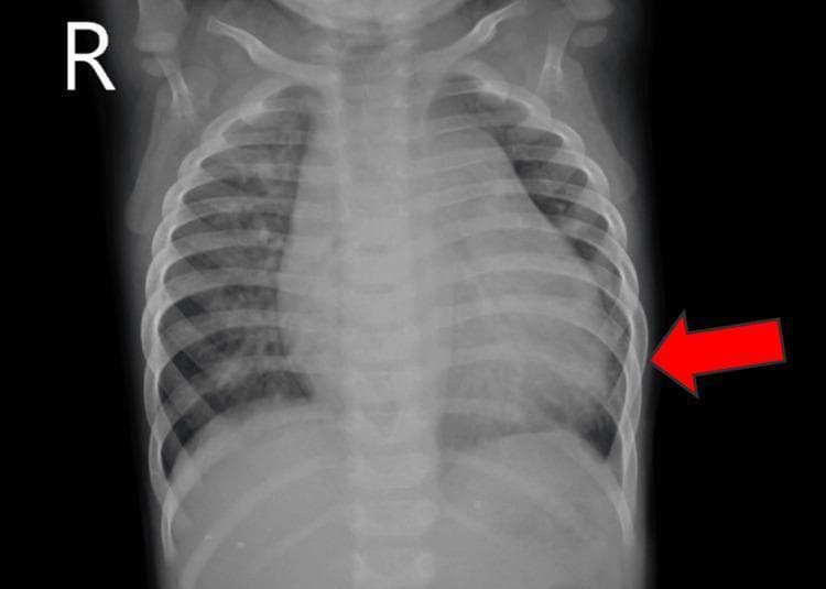 A frontal (anteroposterior) pediatric chest X-ray demonstrating significant cardiomegaly. The image shows an enlarged cardiac silhouette that occupies more than 50% of the thoracic diameter, with a prominent left heart border indicated by a red arrow. The skeletal structures, including the ribs and clavicles, are clearly visible, consistent with a pediatric patient's anatomy. A lateral 'R' marker is present in the upper right field (patient's right). This diagnostic image illustrates the radiological manifestation of heart enlargement, which in this clinical context is associated with congenital heart disease, such as a ventricular septal defect (VSD) and patent ductus arteriosus (PDA). The lung fields appear relatively clear, though there is potential for increased pulmonary vascular markings. This image serves as a teaching tool for identifying cardiomegaly and assessing cardiac size in a pediatric population.