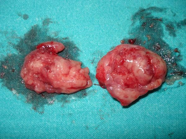 This clinical photograph shows a macroscopically resected specimen of two palatine tonsils following a tonsillectomy, placed on a blue surgical drape. The specimens exhibit an irregular, lobulated, and fleshy surface characteristic of lymphoid tissue. The color is mottled, ranging from pale pink to deep red, indicating varying levels of vascularity and focal areas of hemorrhage or congestion. The surface appears wet and glistening, likely due to serosanguinous fluid and surgical residue. Surrounding the tissues on the drape are visible stains and small fragments of clotted blood. This image serves as a pathological specimen representation of chronic tonsillitis, illustrating the anatomical appearance of inflamed tonsillar tissue post-surgical removal in a clinical setting.