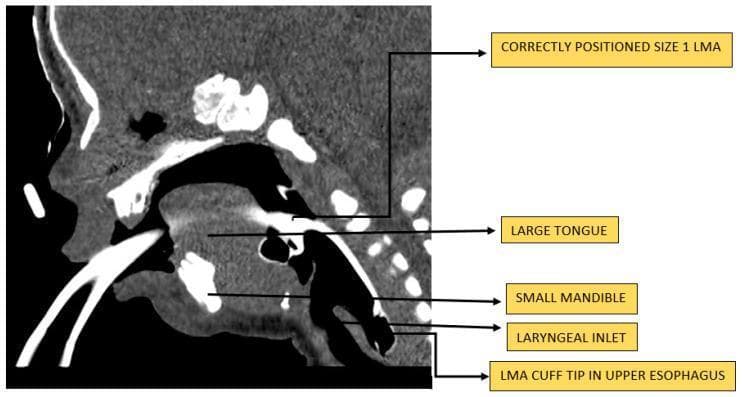 This sagittal CT scan of a neonate illustrates the placement of a size 1 laryngeal mask airway (LMA) in the context of congenital upper airway obstruction. The patient exhibits severe micrognathia, evidenced by a significantly small mandible, and macroglossia, where a large tongue occupies the majority of the oral cavity, contributing to mechanical obstruction. The LMA is seen correctly positioned with the ventilatory pathway bypassing the oral obstruction. The distal cuff is inflated within the hypopharynx, forming a perilaryngeal seal over the laryngeal inlet, while the tip of the cuff is situated in the upper esophagus. The image serves as a clinical demonstration of using a supraglottic airway device (SGAD) to maintain patency in neonatal patients with difficult anatomical airways, such as those found in Pierre Robin sequence or similar craniofacial anomalies. Key anatomical landmarks including the laryngeal inlet, tongue, and mandible are labeled to correlate the device positioning with the infant's specific pathology.