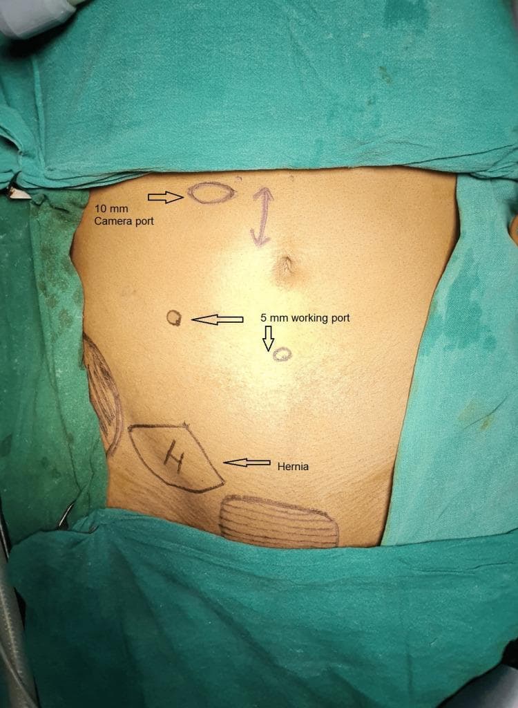 A clinical photograph shows the preoperative abdominal surface markings for an extended totally extraperitoneal (eTEP) hernia repair. The patient is in a supine position, draped with green surgical cloths. Annotated markings on the skin indicate planned laparoscopic port placements: a 10 mm camera port is marked superiorly and slightly lateral to the midline, and two 5 mm working ports are marked in the mid-abdominal region to facilitate triangulation. The umbilicus is identified with a vertical double-headed arrow. In the lower left quadrant (patient's right), a trapezoidal area is labeled 'H' for Hernia, along with anatomical sketches indicating the inguinal region and musculature. This visual serves as a surgical planning guide for the eTEP approach, emphasizing the caudal-to-cranial port configuration used to access the preperitoneal space for inguinal hernia mesh placement without entering the peritoneal cavity.