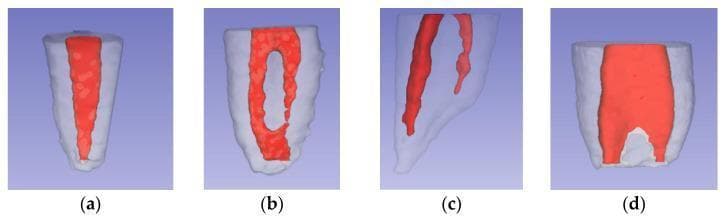 This anatomical diagram displays four three-dimensional reconstructions (labeled a-d) illustrating Weine’s classification of root canal morphology, a critical concept in endodontics. The images use color-coding where the translucent grey/white outer structure represents the tooth root dentin and the solid red internal structure represents the pulp canal system. Panel (a) shows Type I: a single continuous canal extending from the pulp chamber to one apical foramen. Panel (b) depicts Type II: two distinct canals that originate separately in the coronal portion but converge and fuse to exit through a single apical foramen. Panel (c) illustrates Type III: two independent canals that remain separate throughout the length of the root, terminating in two distinct apical foramina. Panel (d) shows Type IV: a single coronal canal that bifurcates in the middle or apical third, ending in two separate apical foramina. This visual comparison serves as an educational tool for identifying variations in root anatomy, informing diagnostic and treatment protocols during root canal therapy.