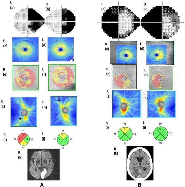 Educational comparison of neuro-ophthalmological findings in two patients (A and B) with occipital lobe infarctions and secondary retrograde trans-synaptic degeneration. Each case includes Humphrey visual field tests (a-b), Optical Coherence Tomography (OCT) ganglion cell-inner plexiform layer (GCIPL) thickness/deviation maps (c-f), Retinal Nerve Fiber Layer (RNFL) thickness/quadrant maps (g-j), and neuroimaging (k). Case A demonstrates a left occipital infarction on diffusion-weighted MRI resulting in right homonymous hemianopia with macular sparing and diffuse bilateral GCIPL thinning on OCT deviation maps. Case B shows a subacute right occipital infarction on CT associated with left homonymous hemianopia and corresponding right-sided homonymous hemi-GCIPL thinning. The RNFL quadrant analysis (i-j) utilizes standard color coding: green for within normal limits, yellow for borderline (p < 5%), and red for outside normal limits (p < 1%). This image illustrates the correlation between central nervous system lesions and retrograde retinal structural changes, highlighting the diagnostic utility of OCT in neuro-ophthalmological evaluation.