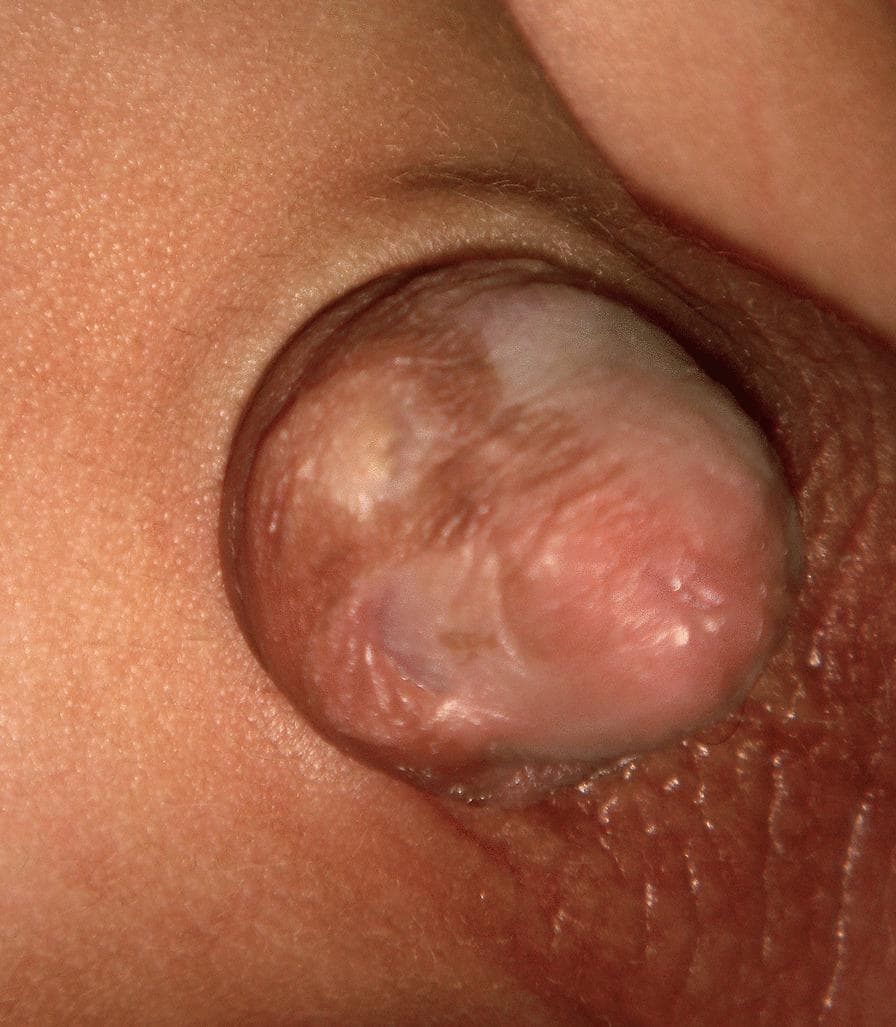 This clinical photograph displays the glans penis of a circumcised patient, illustrating sequelae of balanitis xerotica obliterans (BXO), also known as lichen sclerosus. The glans exhibits a variegated or mottled appearance characterized by areas of hyperpigmentation and atrophic hypopigmentation (whitening). The surface texture is notably altered, showing cicatricial scarring, thickening, and loss of normal mucosal smoothness. Distinctive features include a circular hyperpigmented scar near the coronal sulcus and evidence of skin bridges—fibrous adhesions connecting the penile shaft skin to the glans. The urinary meatus area appears involved with sclerotic changes, typical of chronic inflammatory progression in BXO. This image serves as an educational example of post-circumcision pigmentary and structural complications related to chronic inflammatory dermatoses of the male genitalia, highlighting the visual hallmarks of glandular scarring and dyspigmentation.