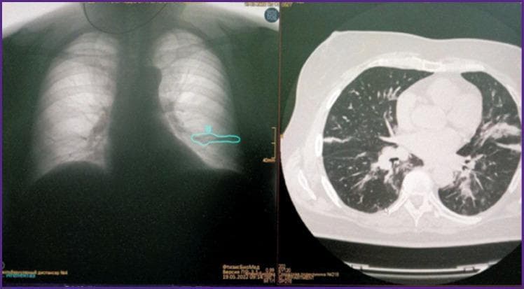 A comparison image displaying a posterior-anterior chest X-ray (left) and a corresponding axial computed tomography (CT) scan (right) of the same patient. The chest X-ray illustrates a horizontal, linear opacity in the lower lobe of the right lung, highlighted by a cyan contour from an AI diagnostic tool, suggesting localized lung collapse. The right panel shows a high-resolution axial CT scan in a lung window, which definitively characterizes the pathology as discoid atelectasis. Visible features on the CT include a band-like, transverse opacity located in the right lower lobe, parallel to the diaphragm, accompanied by focal volume loss and mild adjacent pleural thickening. This image set demonstrates the diagnostic transition from a projectional screening modality (X-ray) to a cross-sectional confirmatory modality (CT) for identifying plate-like atelectasis and differentiating it from other pulmonary infiltrates or pleural pathologies.