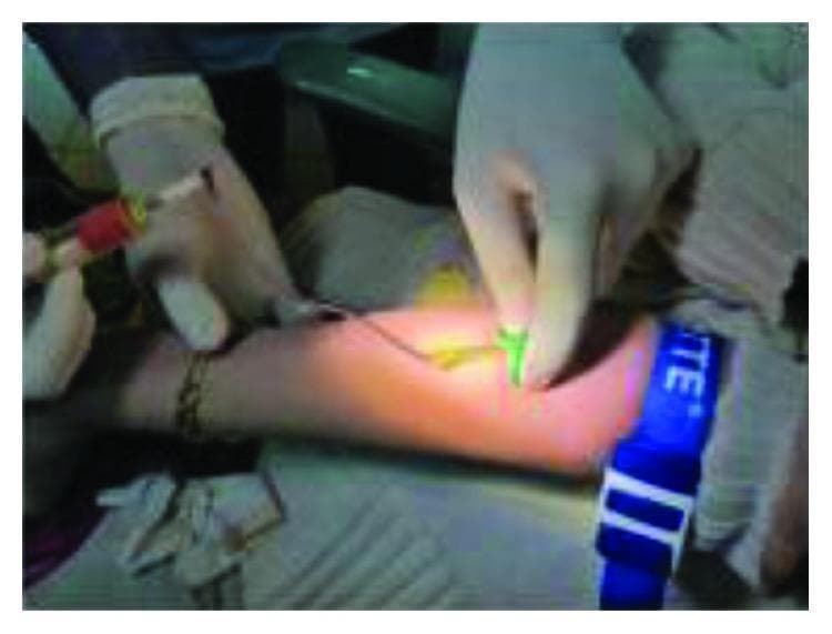 This clinical photograph illustrates a venipuncture procedure for blood collection from the antecubital fossa of a patient's arm. A blue reusable tourniquet is applied to the mid-humerus region to facilitate venous distension. A healthcare professional, wearing white sterile gloves, is performing the procedure using a winged infusion set (butterfly needle), indicated by the green plastic 'wings' held at the puncture site. The needle is connected via flexible tubing to a vacuum-sealed blood collection tube (vacutainer) with a red-stoppered cap. The setup demonstrates standard aseptic technique and equipment used for obtaining venous blood samples, which in this clinical context is being utilized for the subsequent preparation of Leukocyte-Platelet-Rich Fibrin (L-PRF) for surgical use.
