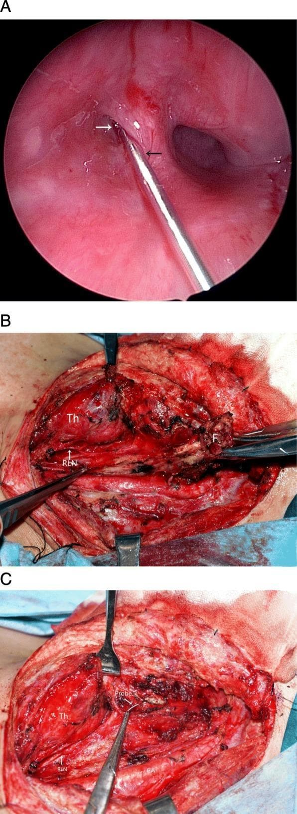 This composite of three images illustrates a surgical resection of a branchial pouch sinus (fourth branchial cleft fistula).
Panel A is an endoscopic view of the piriform fossa, showing a metal probe (black arrow) inserted into the internal opening (white arrow) of the fistula tract.
Panels B and C are intraoperative clinical photographs of an open neck dissection. Panel B shows the surgical field with labeled anatomical structures: the thyroid gland (Th), the fistula (F) being retracted, the recurrent laryngeal nerve (RLN) visualized as a thin white strand, and the carotid artery (CA) deeper in the field. Panel C demonstrates the completed tracing and excision of the fistula (F) using the metal probe as a guide. The image highlights the proximity of the fistula to critical neurovascular structures and the thyroid gland, emphasizing the importance of careful dissection to preserve the RLN and CA during the removal of the tract and associated scar tissue.