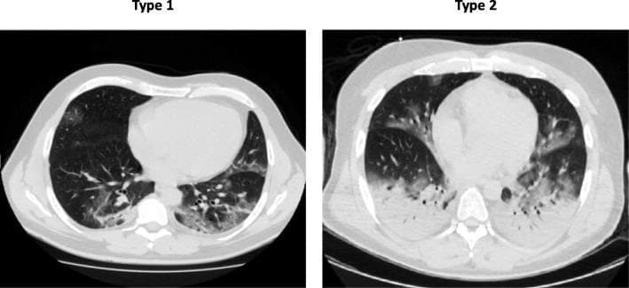 This diagnostic image consists of two axial chest computed tomography (CT) scans, labeled Type 1 and Type 2, illustrating different phenotypes of COVID-19 pneumonia or Acute Respiratory Distress Syndrome (ARDS). Type 1 demonstrates a relatively preserved lung aeration with localized, patchy ground-glass opacities primarily distributed in the posterior and basal regions. In contrast, the Type 2 scan shows significant disease progression, characterized by widespread, bilateral lung involvement with confluent areas of high-density consolidation and markedly reduced aeration, particularly in the dependent zones. The anatomical region focuses on the mid-to-lower thoracic cavity, showcasing the heart and both lung fields. The clinical significance of this comparison highlights the variability in lung compliance and pathophysiology despite similar levels of hypoxemia, distinguishing between a low-elastance/high-gas-volume phenotype (Type 1) and a high-elastance/low-gas-volume phenotype (Type 2) typically associated with classic ARDS.
